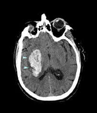 The Mind Project's Virtual Stroke Lab EMR Entry - Reading CT Scans